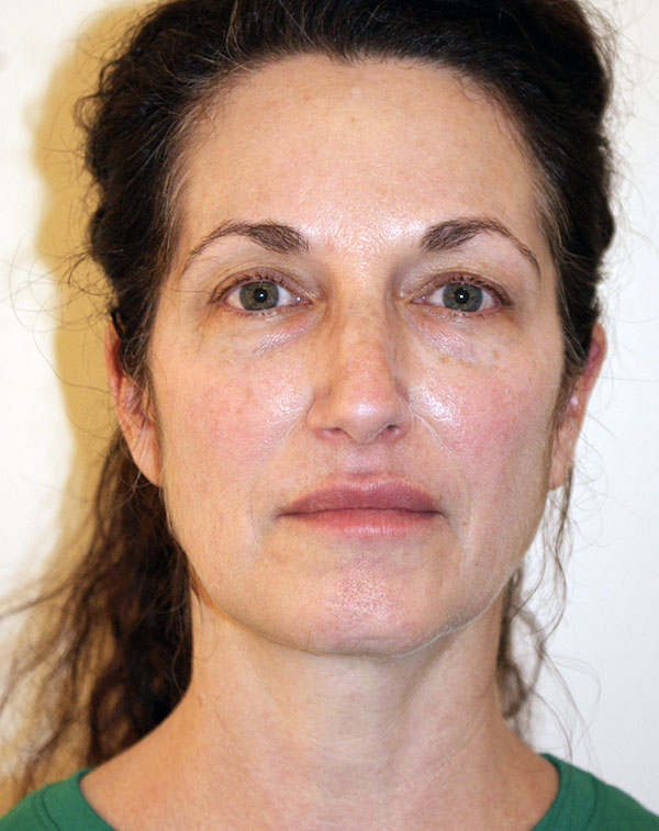 Brow Lift before and after - before