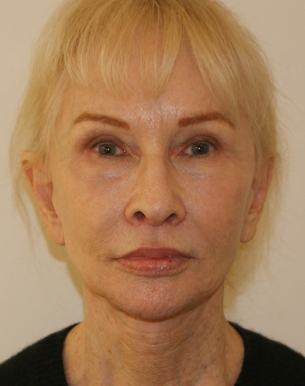 Face and Neck Lift before and after - after