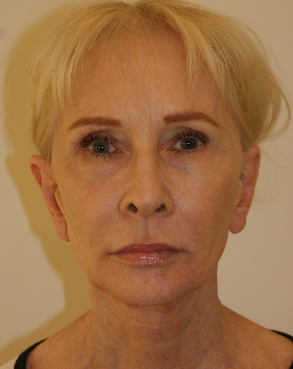 Face and Neck Lift before and after - before