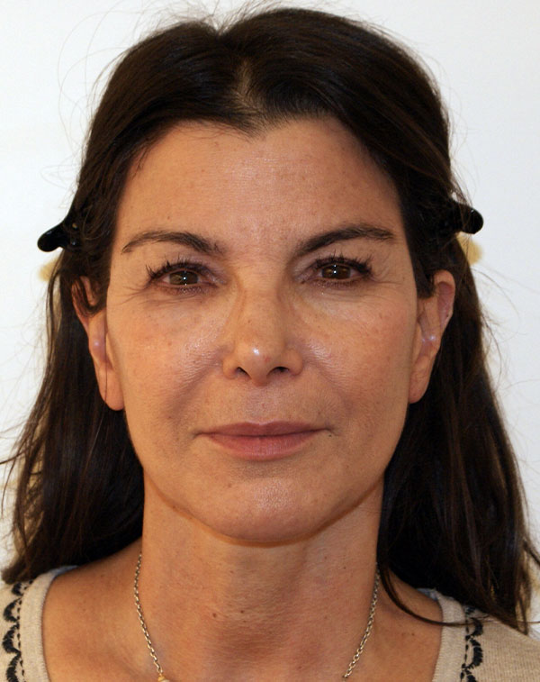 Face and Neck Lift before and after - after