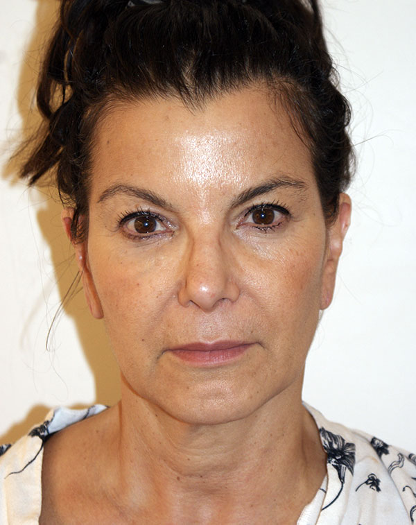 Face and Neck Lift before and after - before