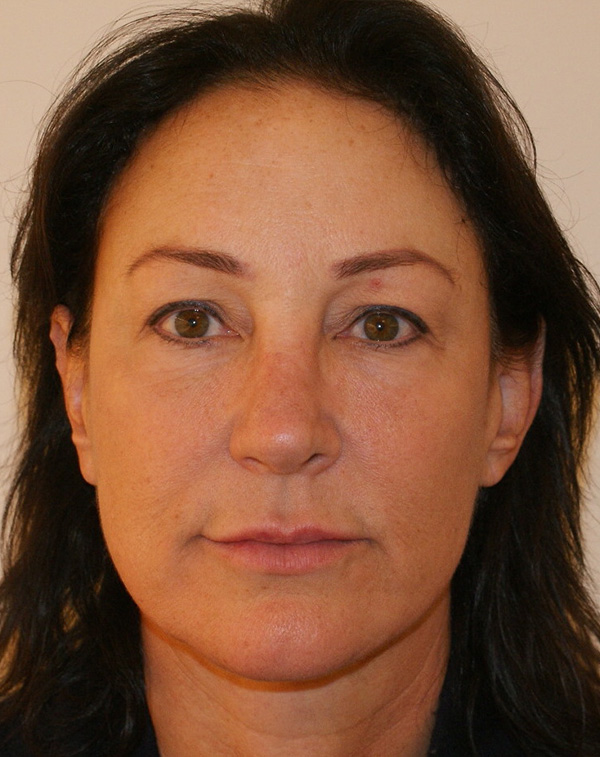 Face and Neck Lift before and after - after