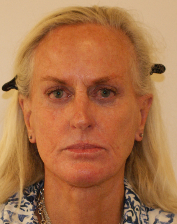 Face and Neck Lift before and after - after
