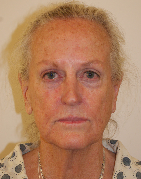 Face and Neck Lift before and after - before