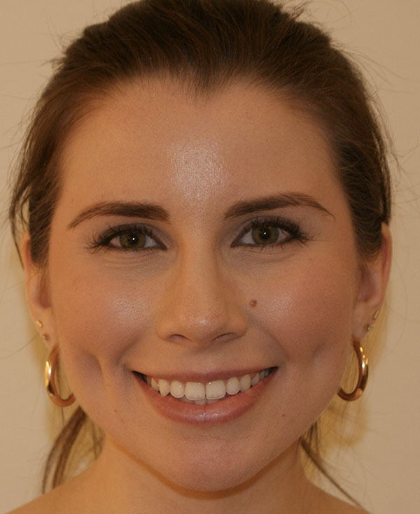 Rhinoplasty before and after - after