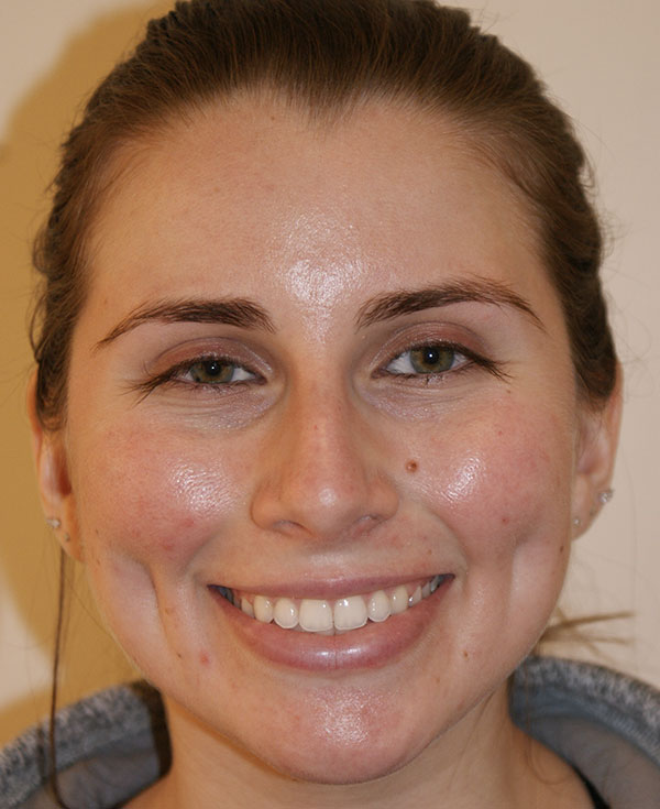 Rhinoplasty before and after - before