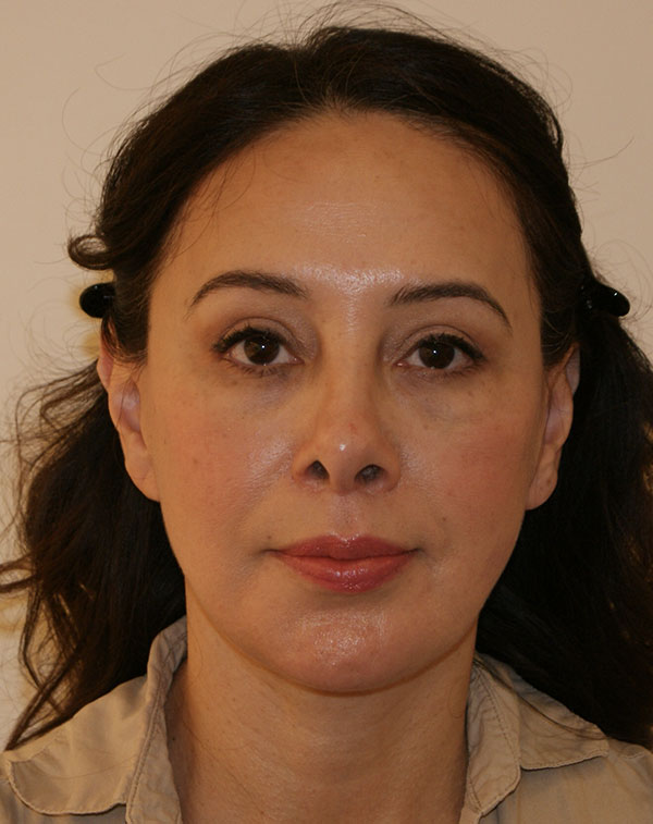 Face and Neck Lift before and after - after