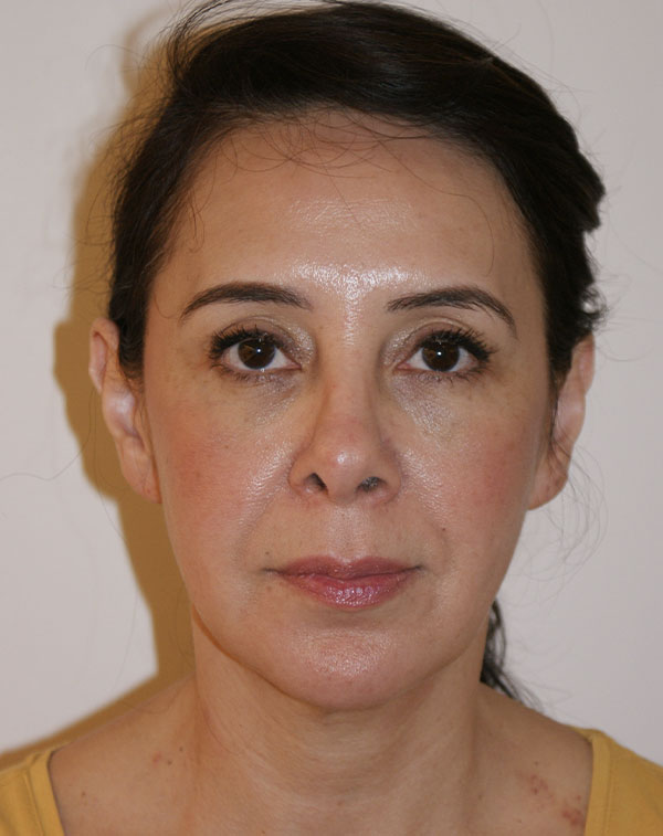 Face and Neck Lift before and after - before