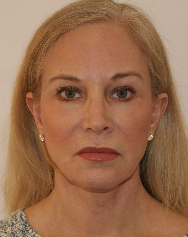 Facial Fat Transfer before and after - after