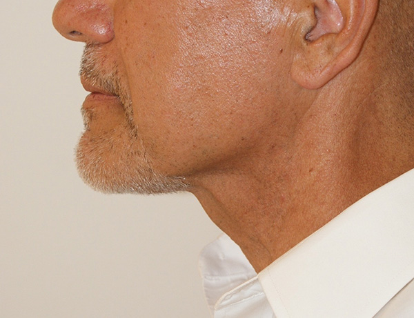 Short Scar Neck Lift before and after - after