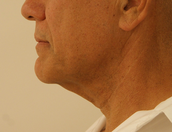 Short Scar Neck Lift before and after - before