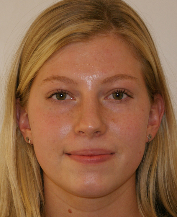 Rhinoplasty before and after - after