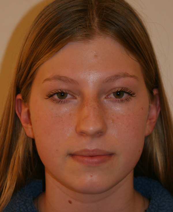 Rhinoplasty before and after - before