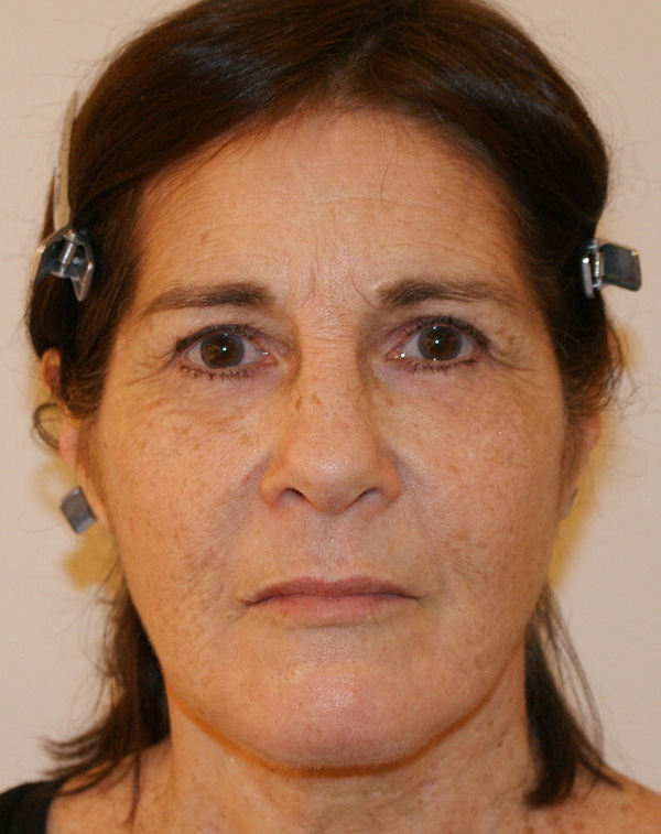 Face and Neck Lift before and after - after