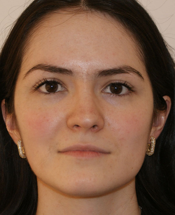 Rhinoplasty before and after - after