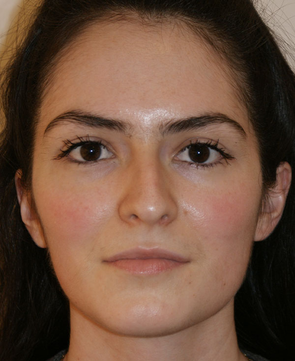 Rhinoplasty before and after - before