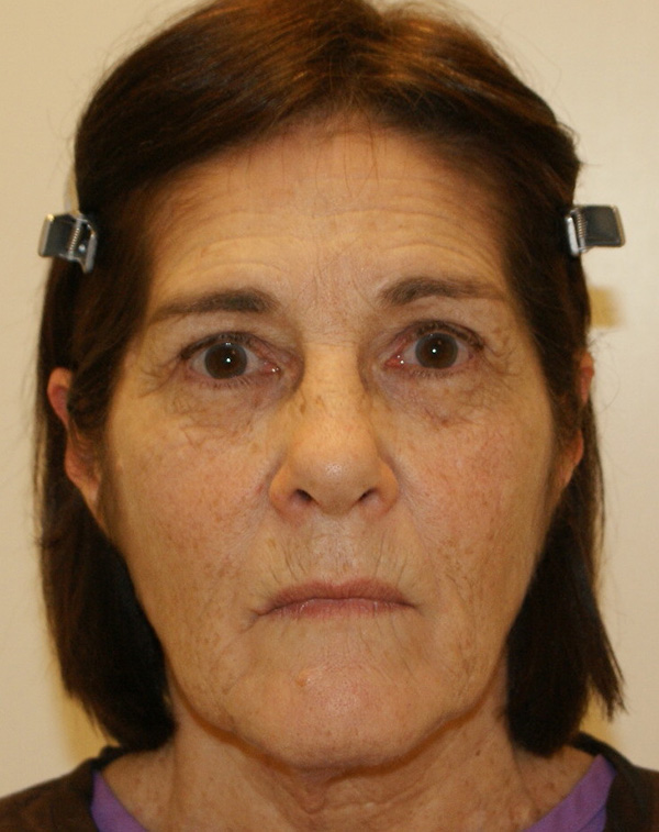 Facial Fat Transfer before and after - before