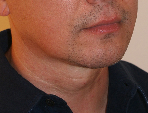 Short Scar Neck Lift before and after - after