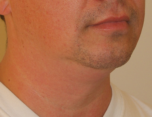 Short Scar Neck Lift before and after - before