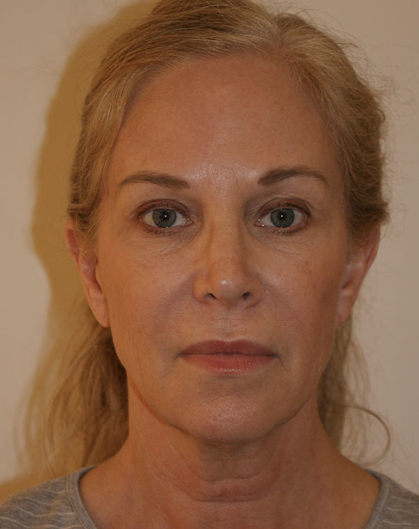 Face and Neck Lift before and after - before