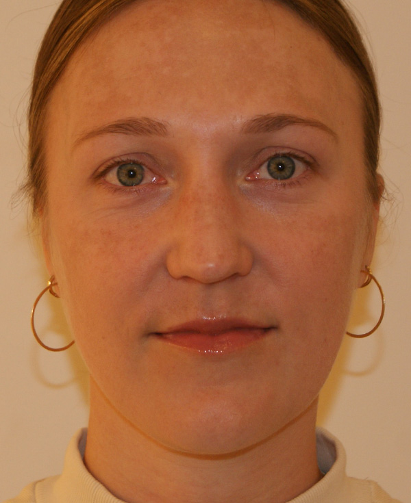 Rhinoplasty before and after - after