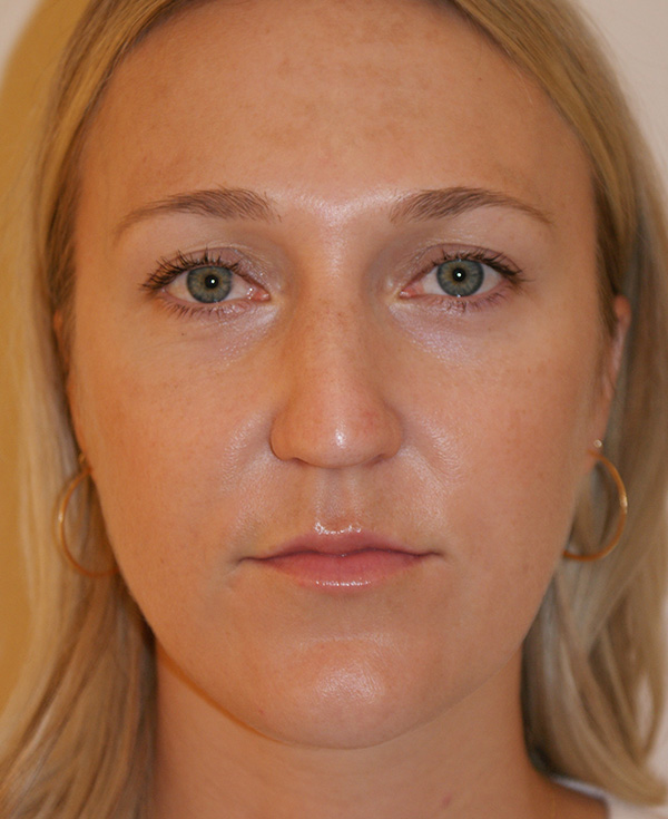 Rhinoplasty before and after - before