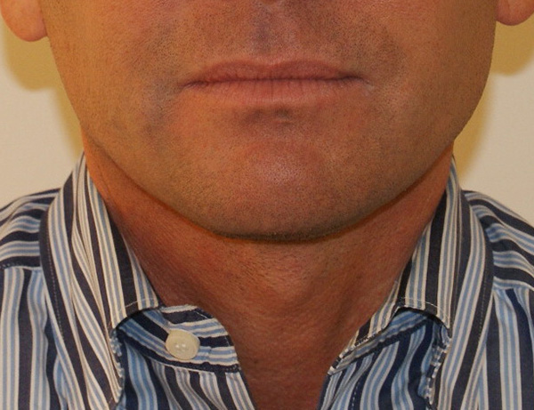 Short Scar Neck Lift before and after - after