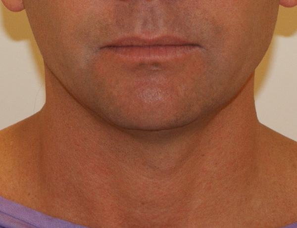 Short Scar Neck Lift before and after - before