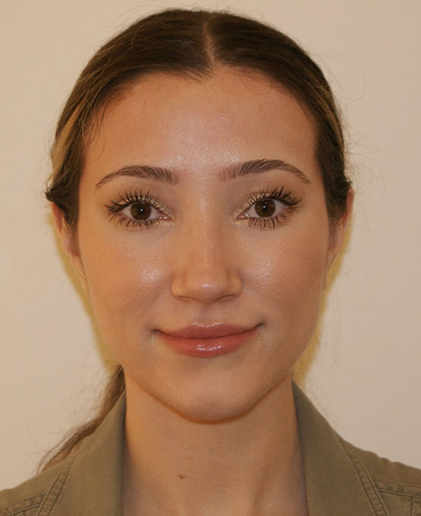 Rhinoplasty before and after - after