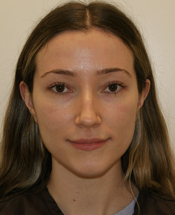 Rhinoplasty before and after - before