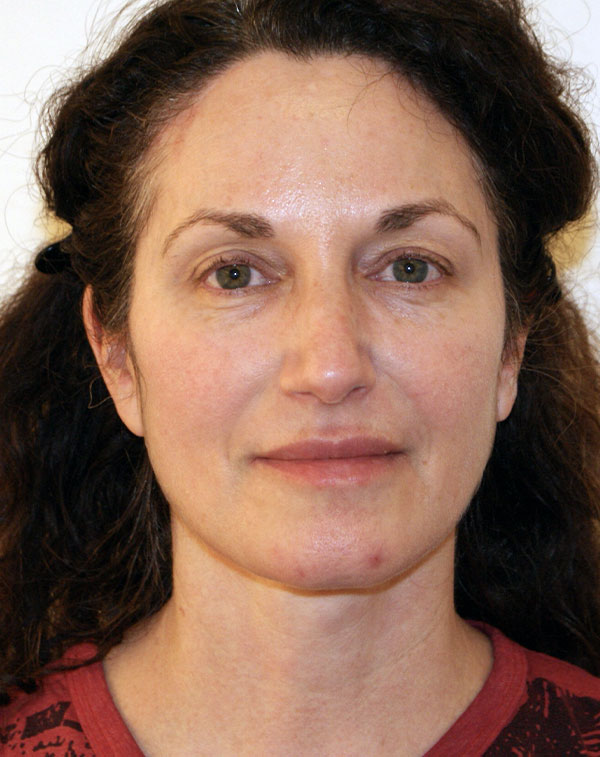 Facial Fat Transfer before and after - after