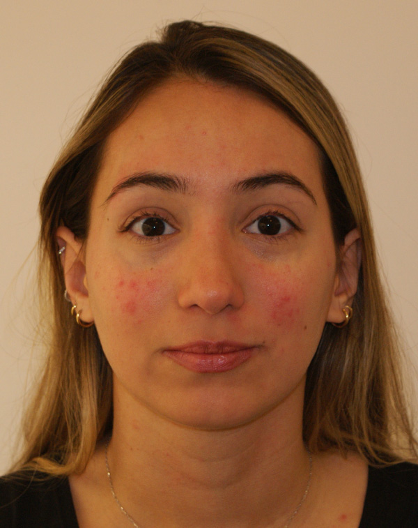 Rhinoplasty before and after - after