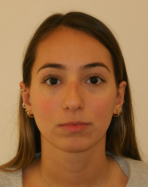 Rhinoplasty before and after - before