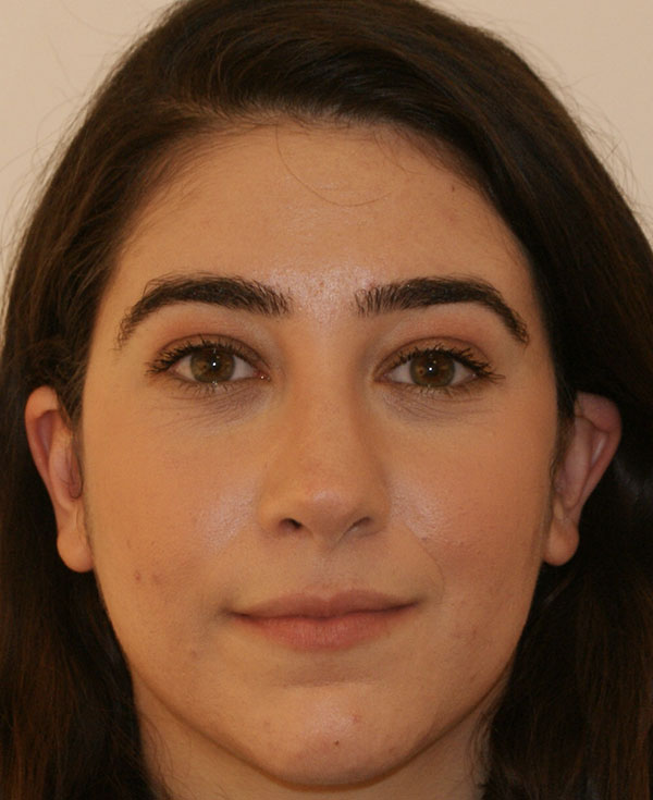 Rhinoplasty before and after - after