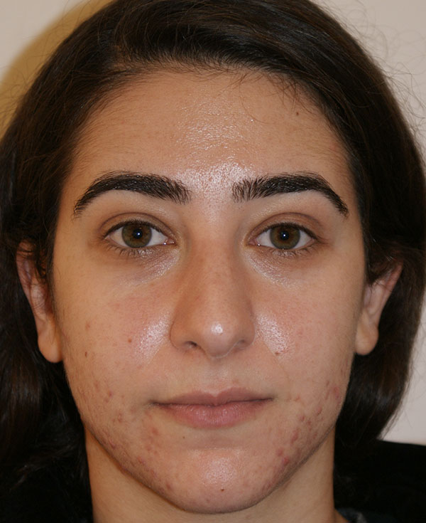 Rhinoplasty before and after - before