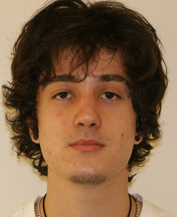 Rhinoplasty before and after - after
