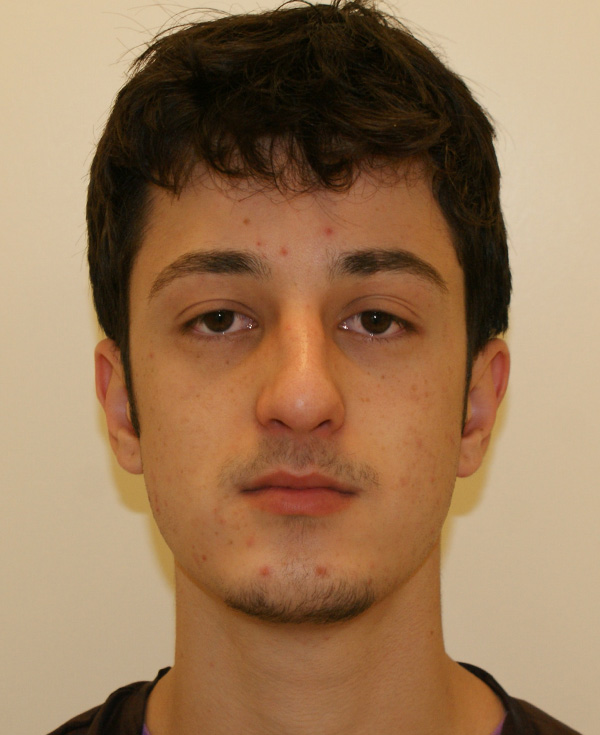 Rhinoplasty before and after - before
