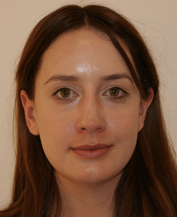 Rhinoplasty before and after - after