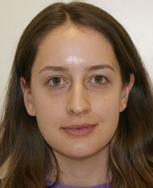 Rhinoplasty before and after - before