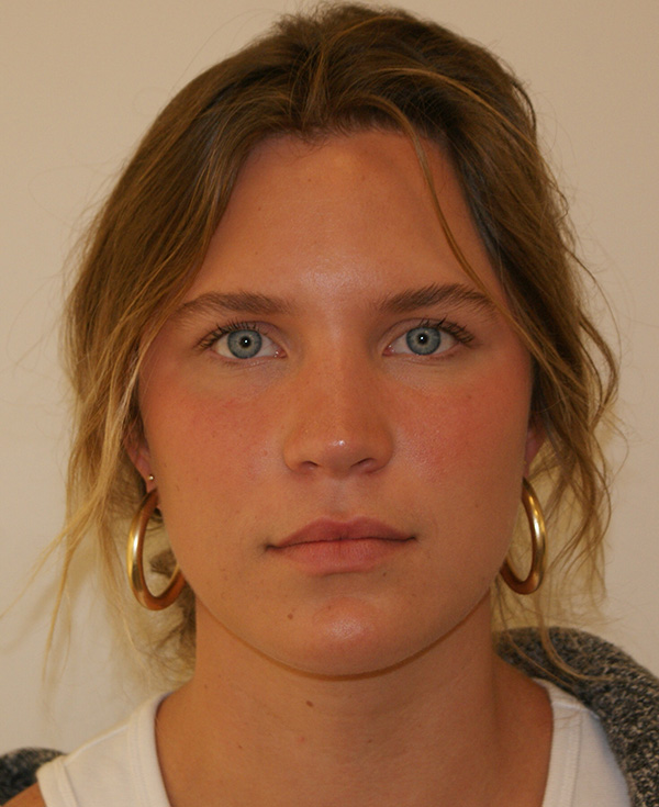 Rhinoplasty before and after - after