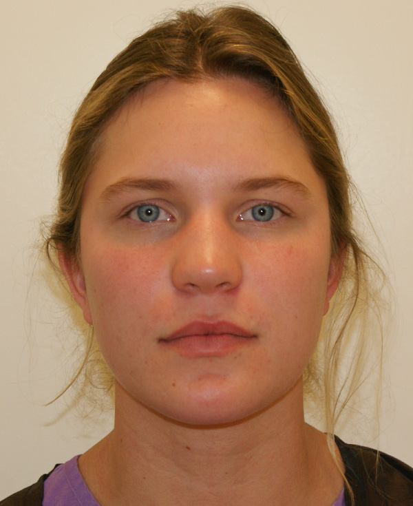 Rhinoplasty before and after - before