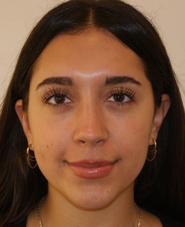 Rhinoplasty before and after - after