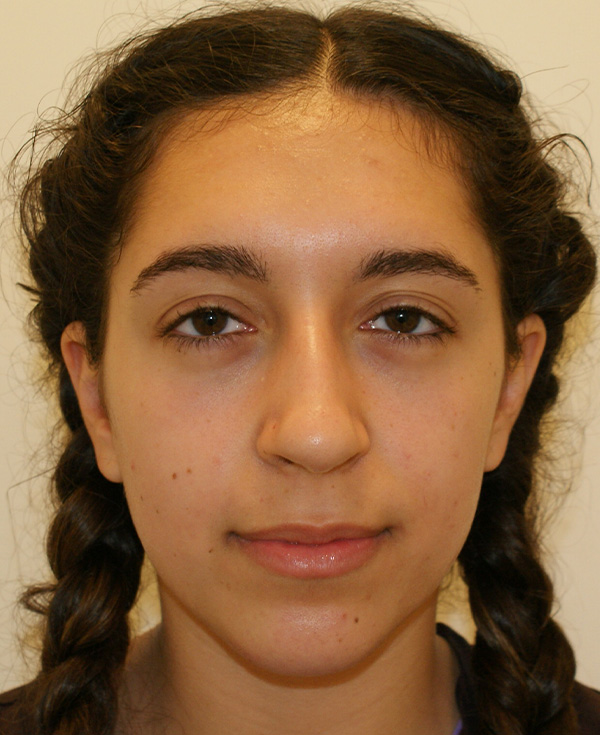 Rhinoplasty before and after - before
