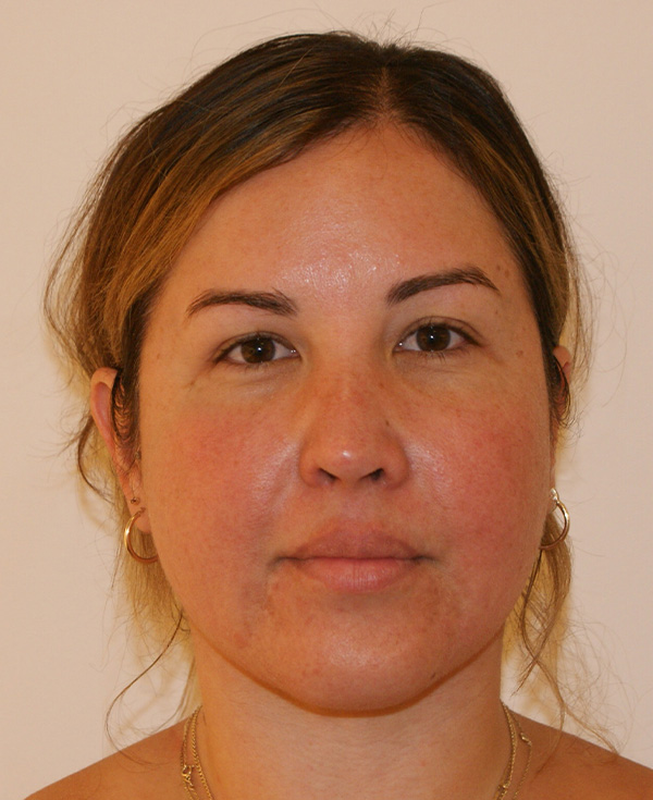 Rhinoplasty before and after - after