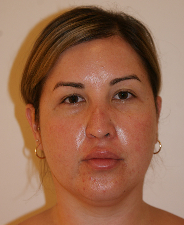 Rhinoplasty before and after - before