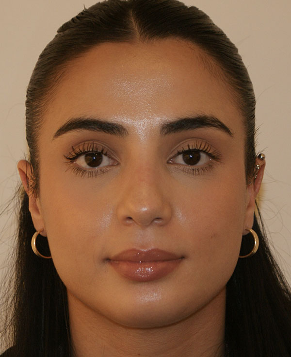 Rhinoplasty before and after - after