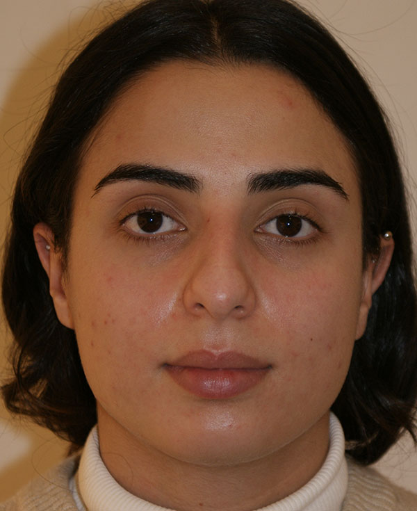 Rhinoplasty before and after - before
