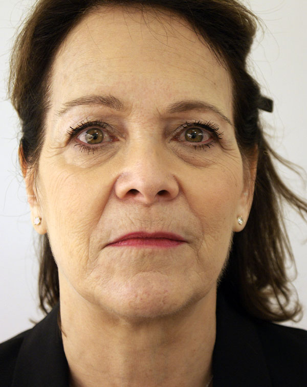 Face and Neck Lift before and after - before