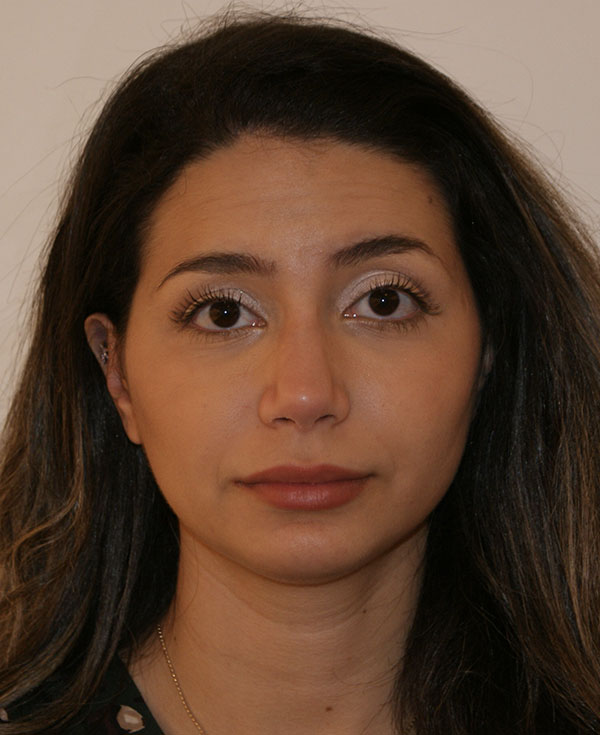 Chin Implants before and after - after