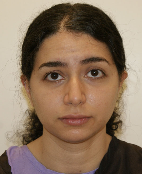 Chin Implants before and after - before